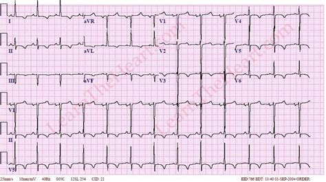 lvh hart